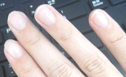 指甲上有竖纹预示什么会是病变吗
