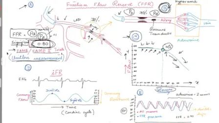 [图]【油管搬运】Coronary Angiogram. FFR (Fractional Flow Reserve)