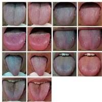 舌苔(5) 舌苔(外文名:coating on the tongue),中医术语,是正常人的舌
