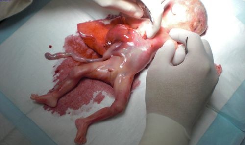 六个月的胎儿可以打掉吗 怀孕六个月能打掉吗
